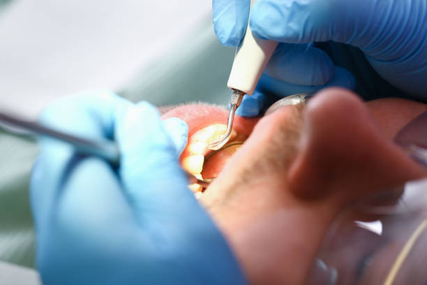 Best Emergency Wisdom Teeth Removal in Ke Charles, LA